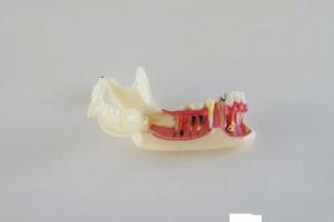 Quality Dental Half Lower Jaw Open Gum Bone Pathological Diseases for sale