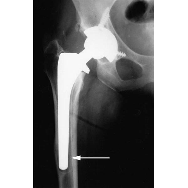 Cemented Artificial Joints Collarless Hip Stem Implantable Artificial Organs