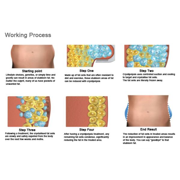 Four Handpiece Cryolipolysis Fat Freeze Slimming Machine With One Year Warranty