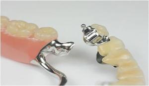 Quality Removable Precision Attachment Partial Denture Stable Professional for sale