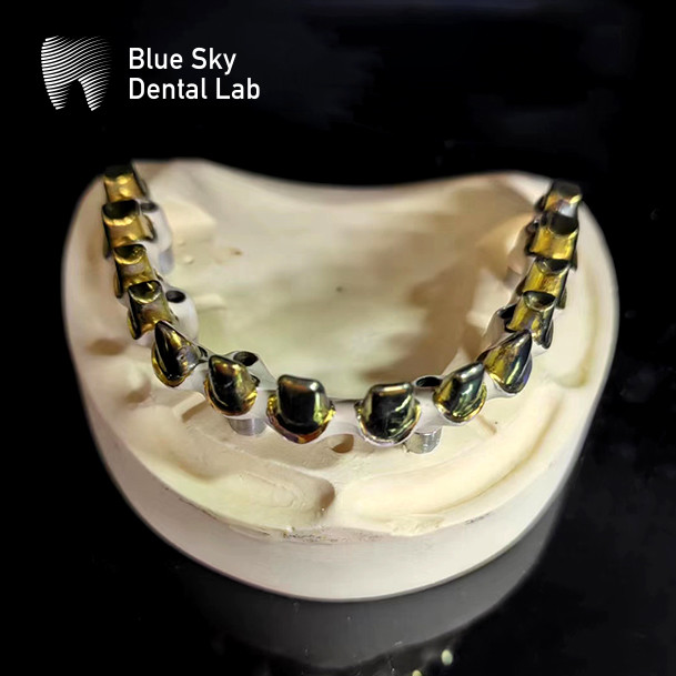 Screw retained MUA abutment Implant Cases Zirconia crowns Multilayer pink porcelain with Easy repair