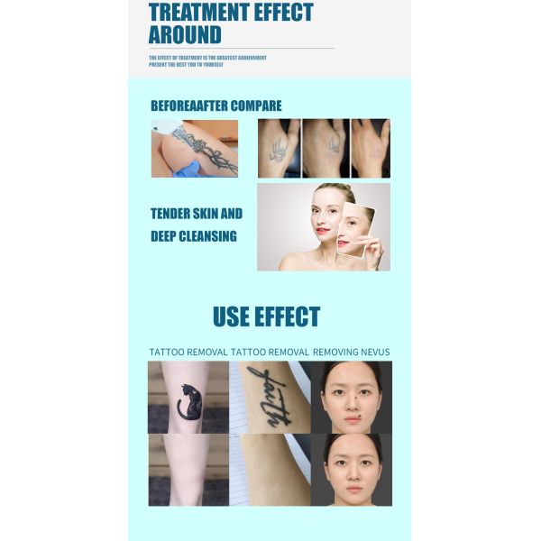 Stationary Q Switched Nd Yag Laser Machine Professional Pico Laser Tattoo Removal Machine 808nm