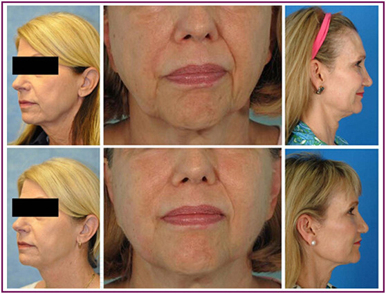 Face Lifting HIFU Machine / High Intensity Focused Ultrasound Machine Mini