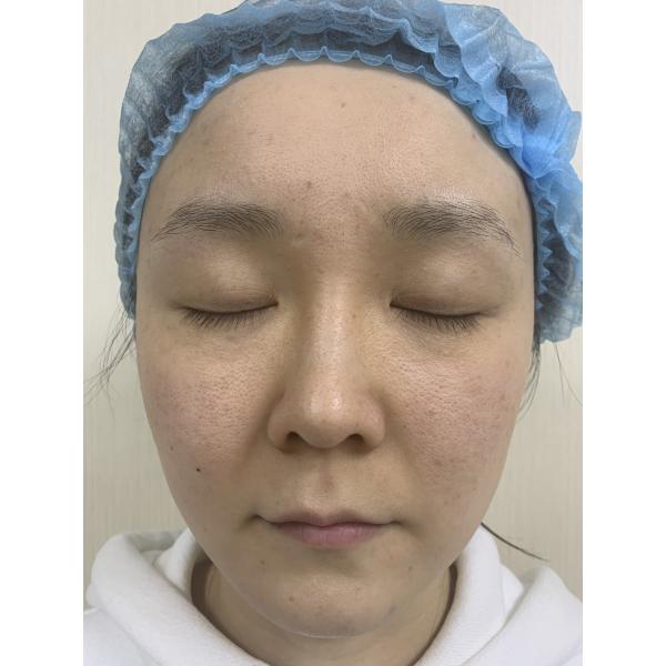 15kg RF Microneedling Machine Skin Tightening Dual operation mode