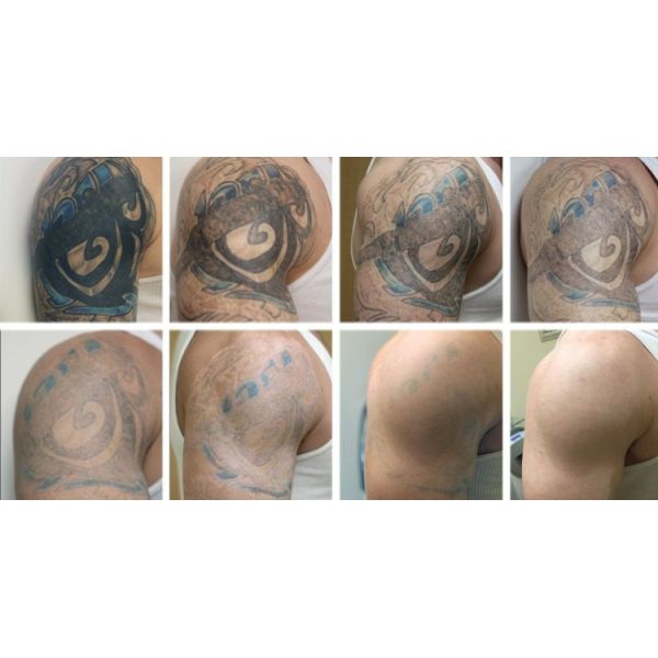 1 - 2000mJ Q Switched Nd Yag Laser Machine Permanent Tattoo Removal Machine Customized