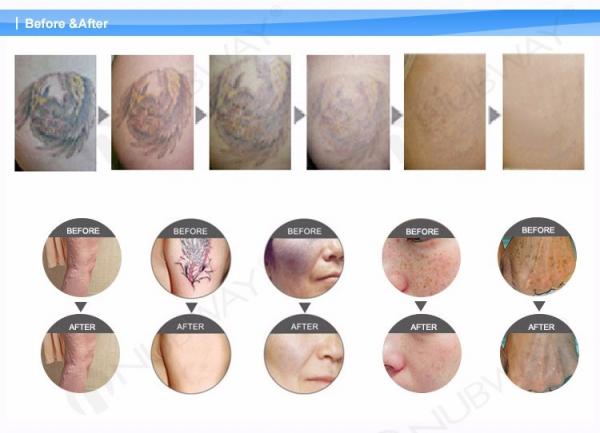 Passive Q switch ND yag laser tattoo removal&pigment removal& skin whitening laser machine