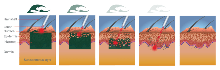 1 - 2000mJ Q Switched Nd Yag Laser Machine Permanent Tattoo Removal Machine Customized