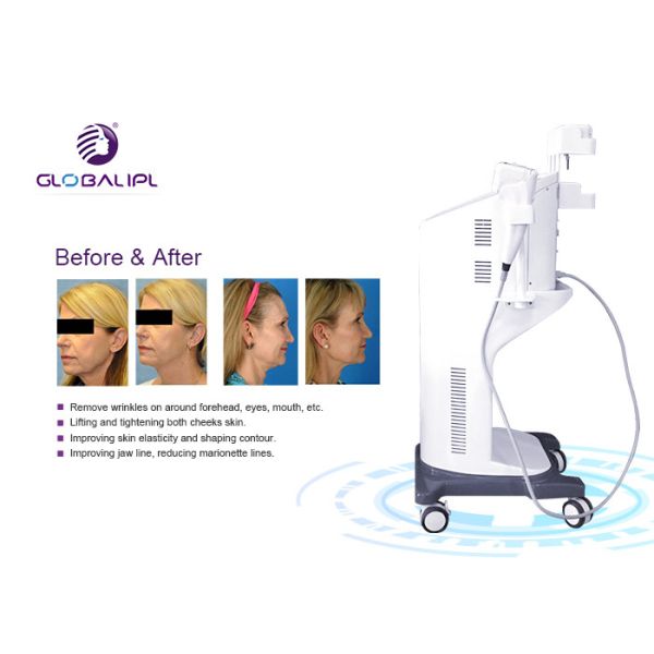 Ultrasound Face Lifting HIFU Machine 25000 Shots Self Developed Patent Technology